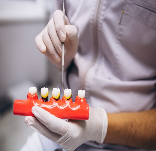 Preparation for a dental bridge on a practice model.